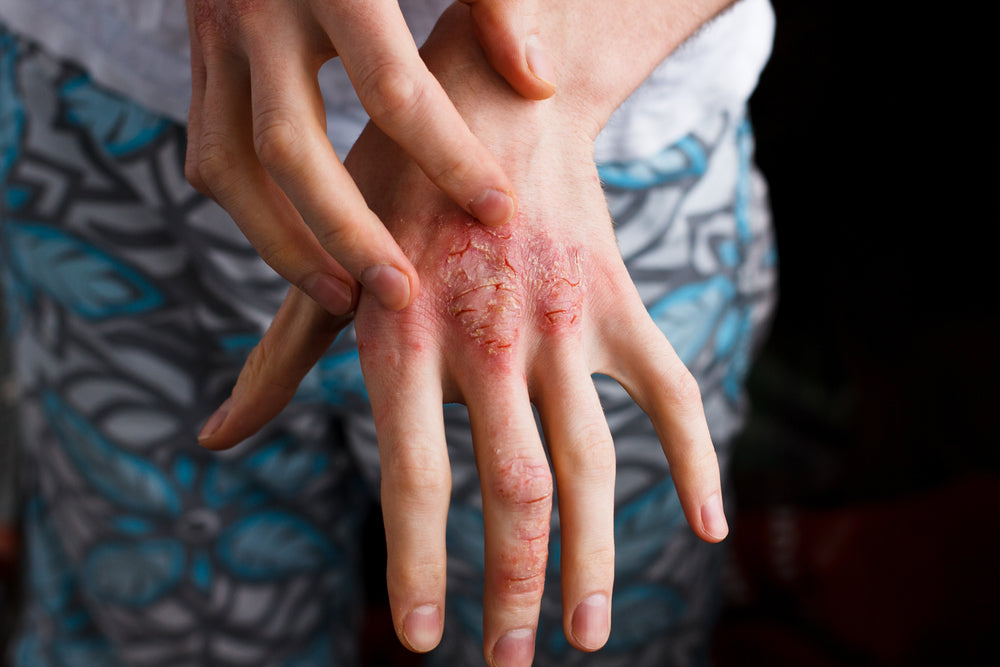 Winter and Covid are challenging for those with Eczema