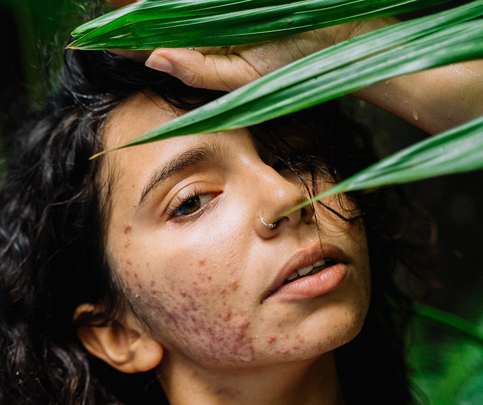 6 Easy Tips to Help Control & Eliminate Acne