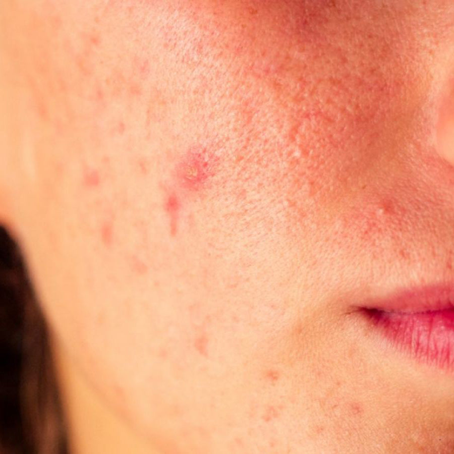Pimples & Acne